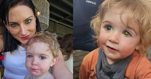 Toddler Loses Sight After Innocent Kiss Turns into a Nightmare